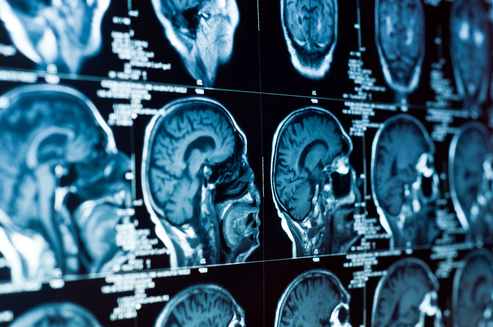 San Diego Head Injury Lawyer: Ensuring Your Legal Rights