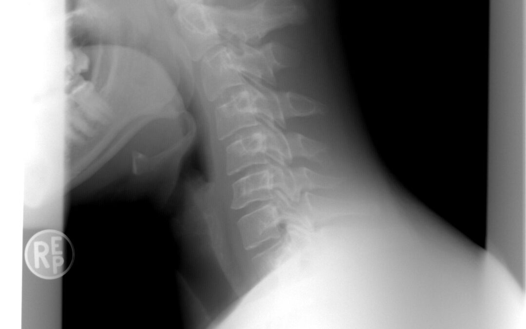 Spinal Cord Injury Lawyer: Advocating for Victims in San Diego