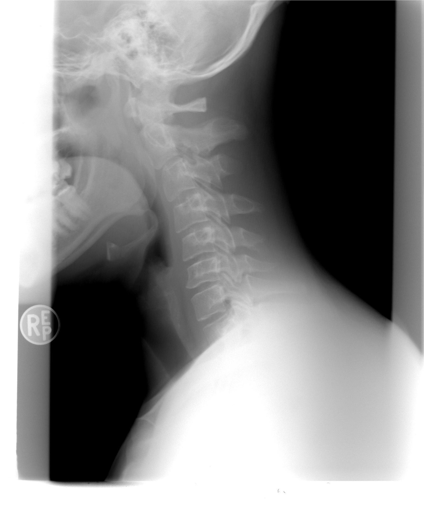 Spinal Cord Injury