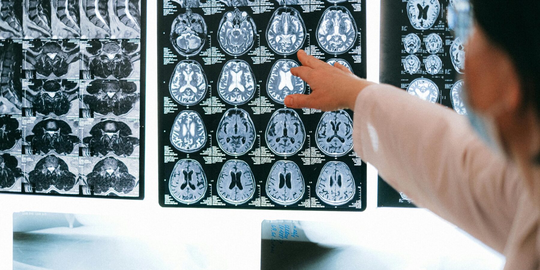 traumatic brain injury scan