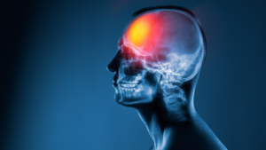 Evidence That Strengthens a Rancho Peñasquitos Traumatic Brain Injury Accident Case